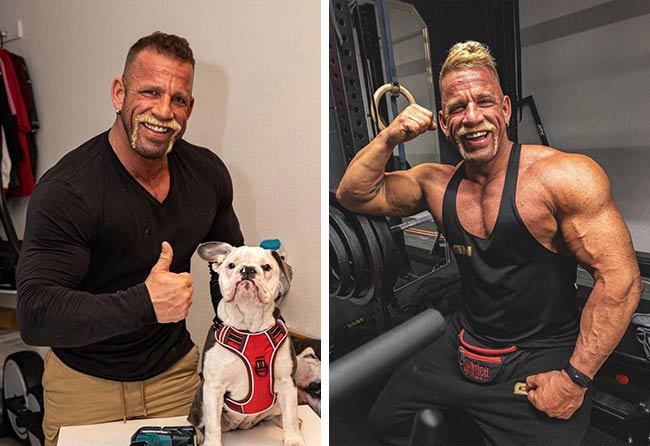 Image resultat greffe de cheveux DHI 2900 greffons Hollywood Matze