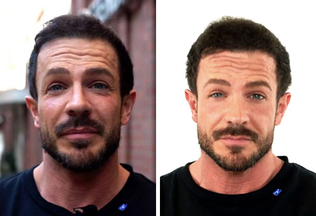 Image resultat greffe de cheveux fue saphir 3500 greffons Simon Teichmann