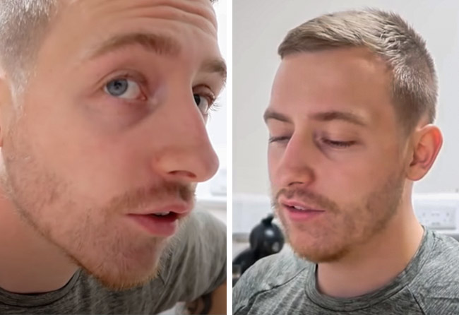 Image 2 mois après implant de barbe saphir 4200 greffons Jay Jones