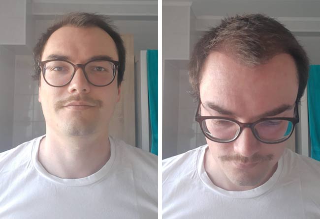 Image 3 mois après greffe de cheveux DHI 3500 greffons Chris Scholz