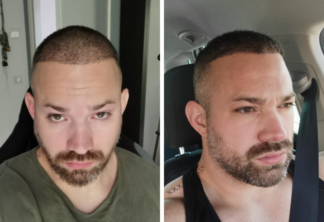 Image 4 mois après greffe de cheveux DHI 3700 greffons Manuel Anderhuber