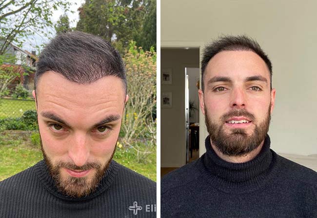 Image 4 mois après greffe de cheveux DHI 3700 greffons Sebastian Kellermann