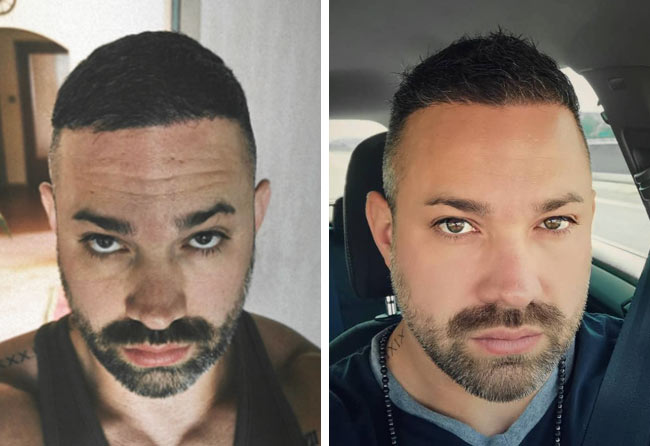 Image 6 mois après greffe de cheveux DHI 3700 greffons Manuel Anderhuber