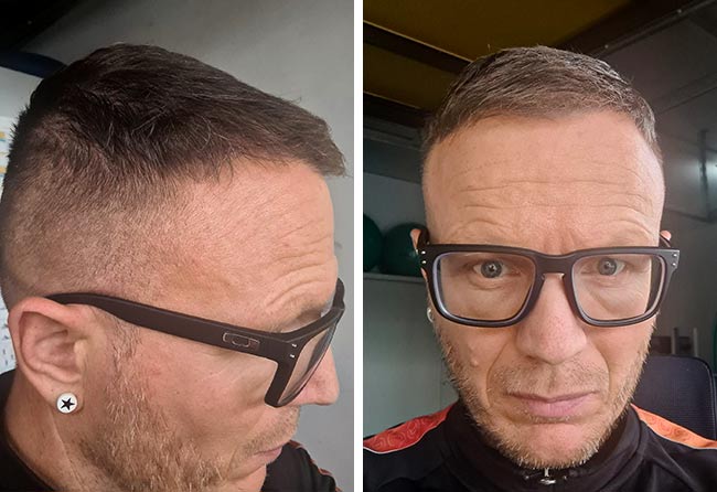 Image 7 mois après greffe de cheveux DHI 4500 greffons Steffen Kraeuter