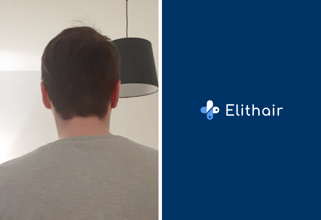 Greffe-de-cheveux-DHI-zone-donneuse-apres-resultat-Chris