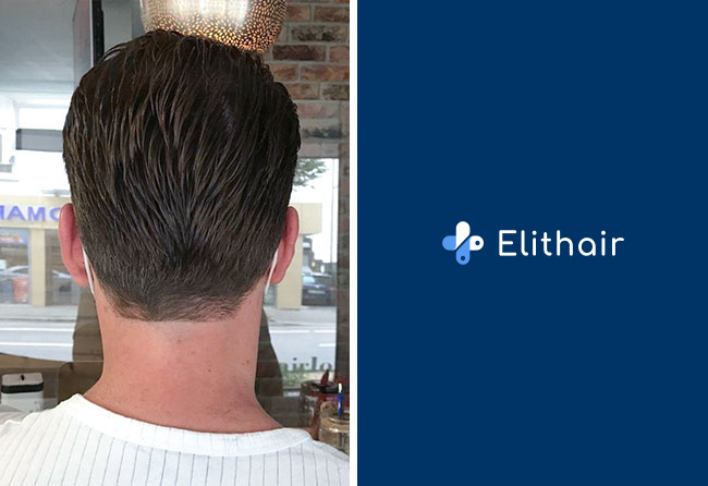 Greffe-de-cheveux-fue-saphir-zone-donneuse-apres-5-mois-Cagatay-T