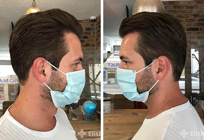 Résultat après greffe de cheveux saphir 4000 greffons Cagatay Tuerkseven