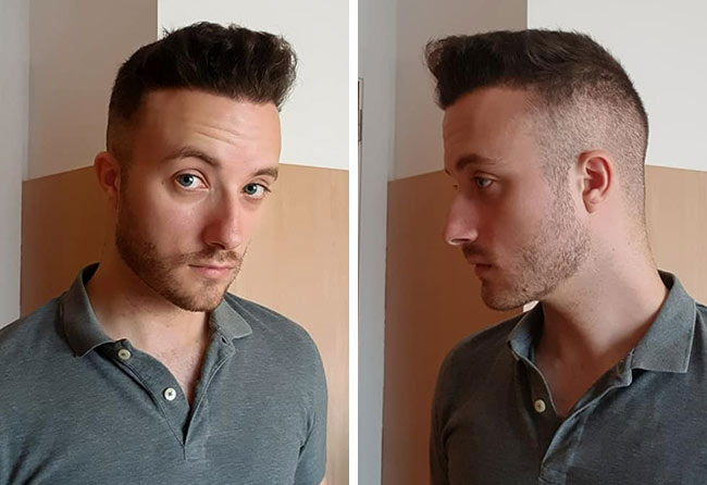Image résultat après greffe de cheveux saphir 4500 greffons Didac Scheffler