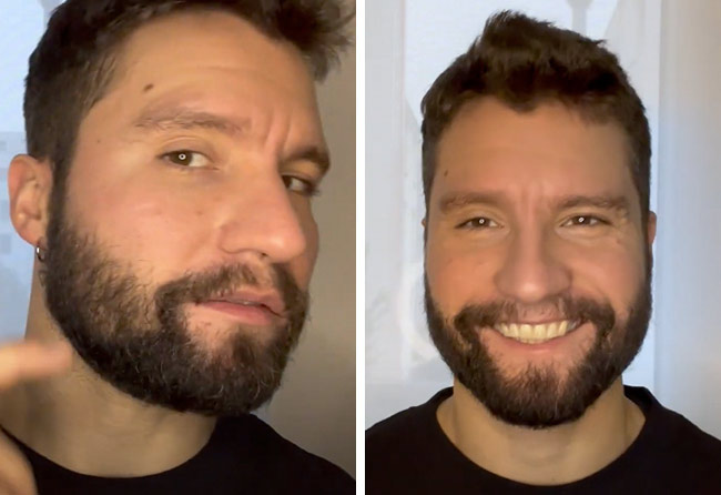 Image résultat après implant de barbe saphir 3500 greffons Dominik Schmitz