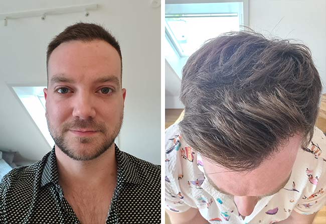 Image 6 mois après greffe de cheveux dhi 2000 greffons Achim Klein