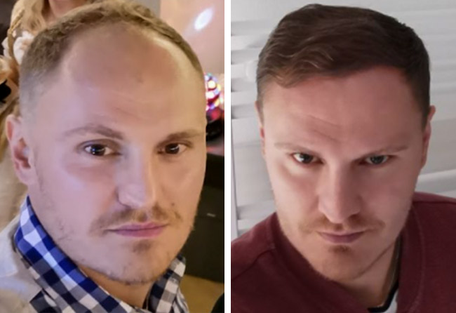 Image avant après greffe de cheveux DHI 3500 greffons Tim Hoffmann