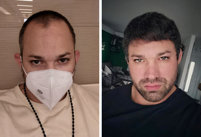 Image avant après greffe de cheveux DHI 3700 greffons Manuel Anderhuber