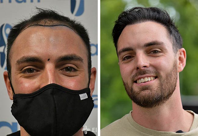 Image avant après greffe de cheveux DHI 3700 greffons Sebastian Kellermann