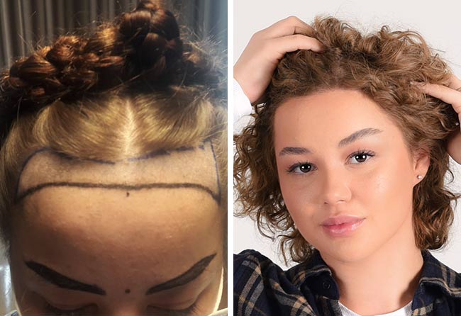 Image avant après greffe de cheveux saphir 2600 greffons Lilianna Steinhoeffel