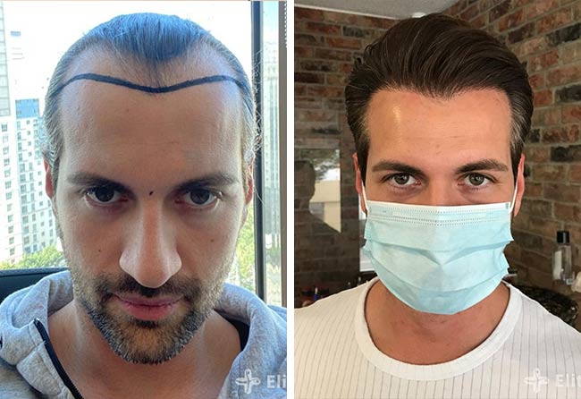 Image avant après greffe de cheveux saphir 4000 greffons Cagatay Tuerkseven