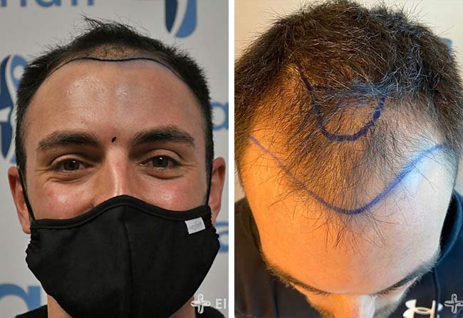 Image avant greffe de cheveux DHI 3700 greffons Sebastian Kellermann