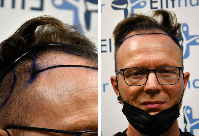 Image avant greffe de cheveux DHI 4500 greffons Steffen Kraeuter