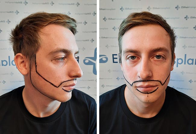 Image avant implant de barbe saphir 4200 greffons Jay Jones