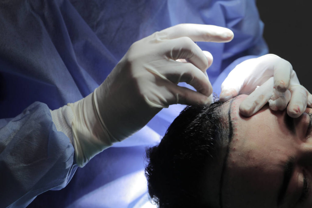 image montrant un chirurgien capillaire elithair enn train d'effectuer une greffe DHI