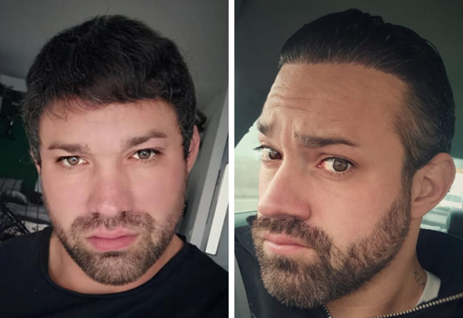 Image résultat après greffe de cheveux DHI 3700 greffons Manuel Anderhuber