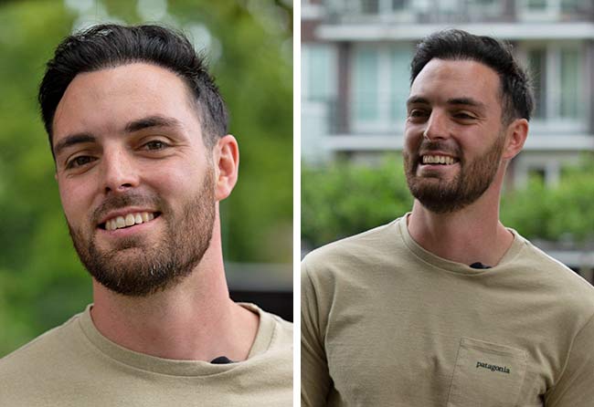 Image résultat après greffe de cheveux DHI 3700 greffons Sebastian Kellermann