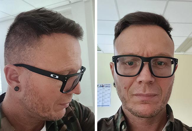 Image résultat après greffe de cheveux DHI 4500 greffons Steffen Kraeuter