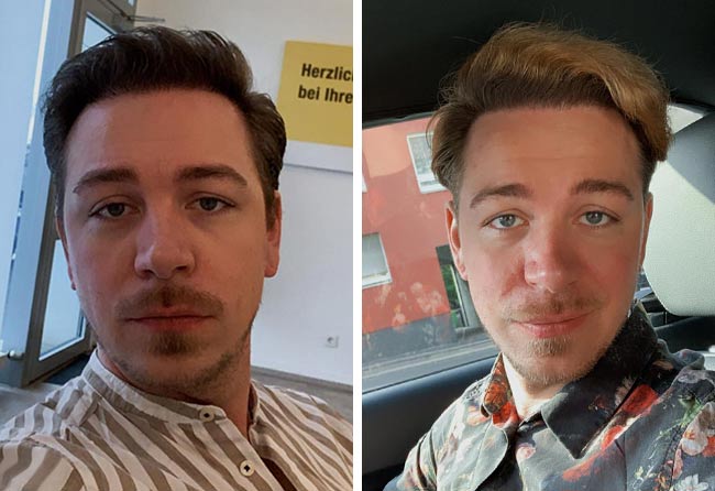 Image résultat après greffe de cheveux DHI 4500 greffons tobias pluemacher