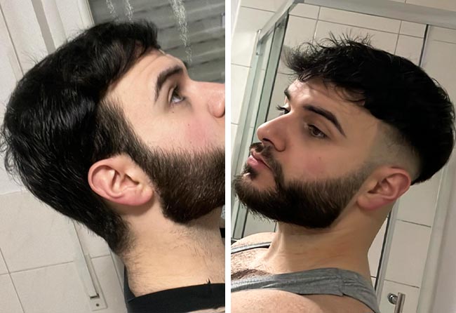 Image résultat après greffe de cheveux DHI 4700 greffons Okan Yueksel