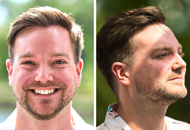 Image résultat après greffe de cheveux dhi 2000 greffons Achim Klein