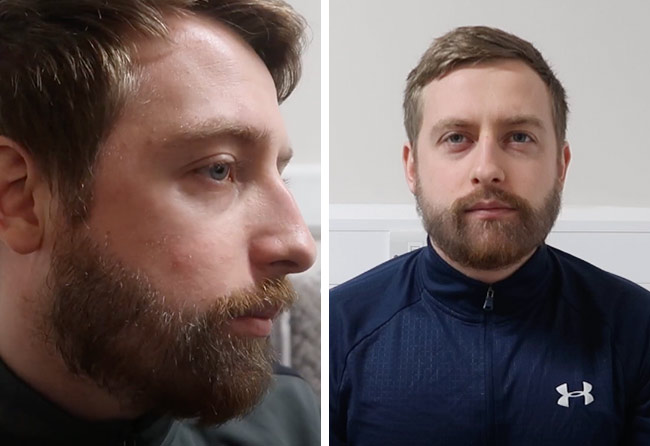 Image résultat après implant de barbe saphir 4200 greffons Jay Jones