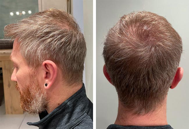 Photo résultat greffe de cheveux DHI tonsure 4750 greffons Raffaele Leucci