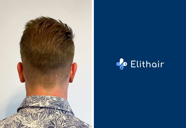 greffe-de-cheveux-dhi-zone-donneuse-apres-resultat-Michael-s