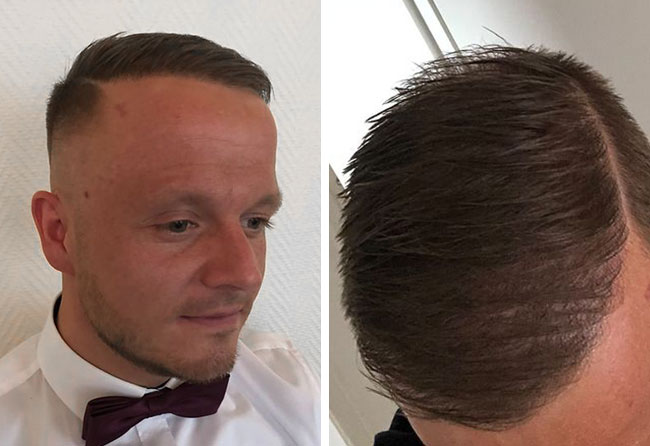 Image résultat greffe de cheveux DHI 5200 greffons Dominik Koenig