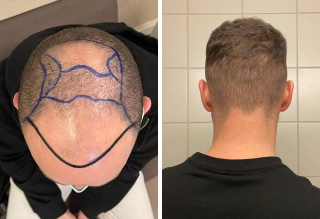 Photo avant après greffe de cheveux DHI tonsure 4700 greffons Kriss Kross