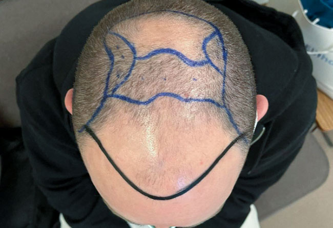 Photo avant greffe de cheveux DHI tonsure 4700 greffons Kriss Kross