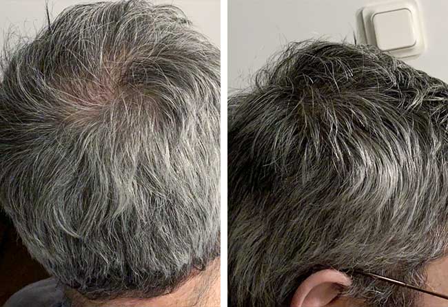 Photo résultat greffe de cheveux saphir 3000 greffons Ziad Ma