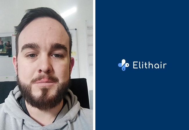 Resultat-greffe-de-barbe-saphir-4300-greffons-Oliver-N