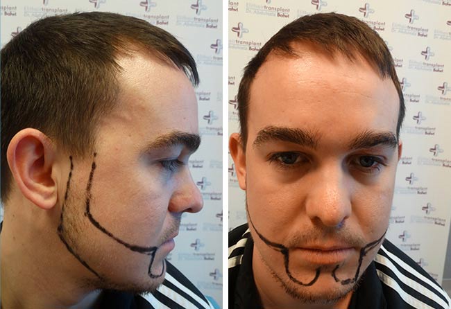 Image avant greffe de barbe saphir 4300 greffons Oliver N