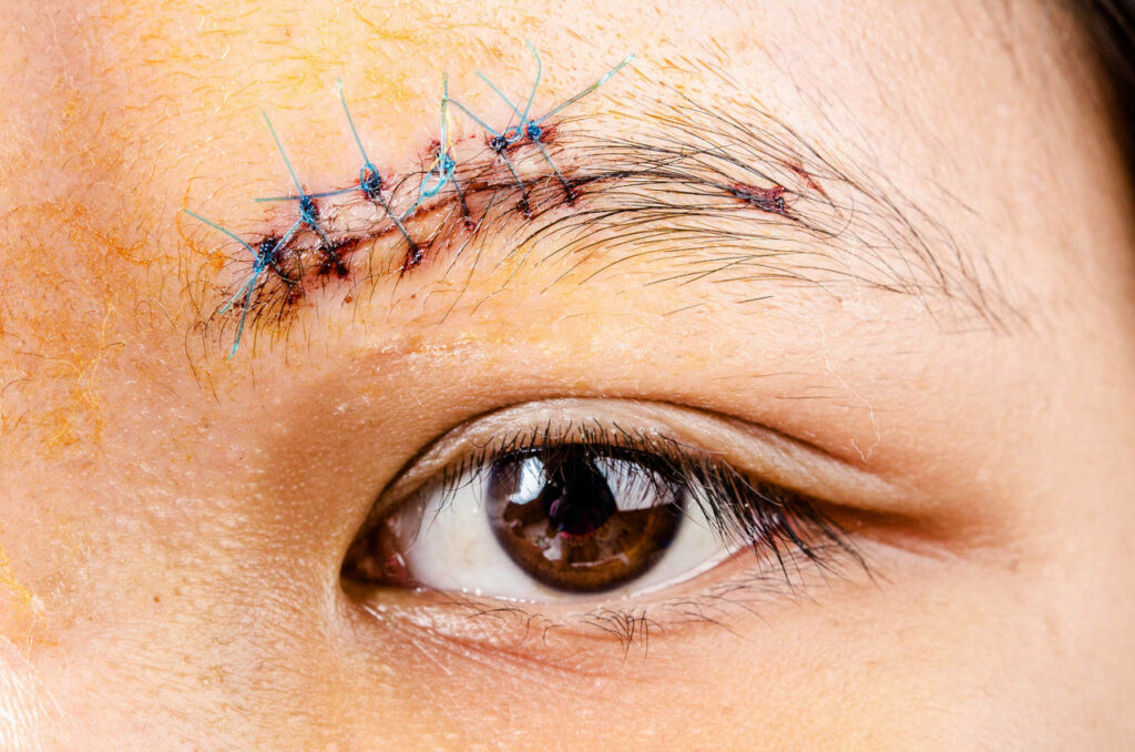 Illustration pour réaliser une greffe de cheveux sur une cicatrice sur un sourcil restaure les poils manquants