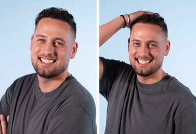 Photo du résultat de la greffe de cheveux de Monier Achahbar