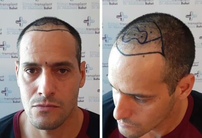 Photo avant la greffe de cheveux saphir avec 3500 greffons de Rawderson Amaral