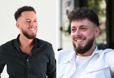 Photo du résultat de la greffe de cheveux dhi avec 3140 greffons de notre patient Cilian White