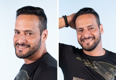 Photo du resultat la greffe de cheveux saphir avec 3500 greffons de Rawderson Amaral