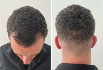 Photo prise 2 mois après la greffe de cheveux dhi avec 3140 greffons du patient Cilian White