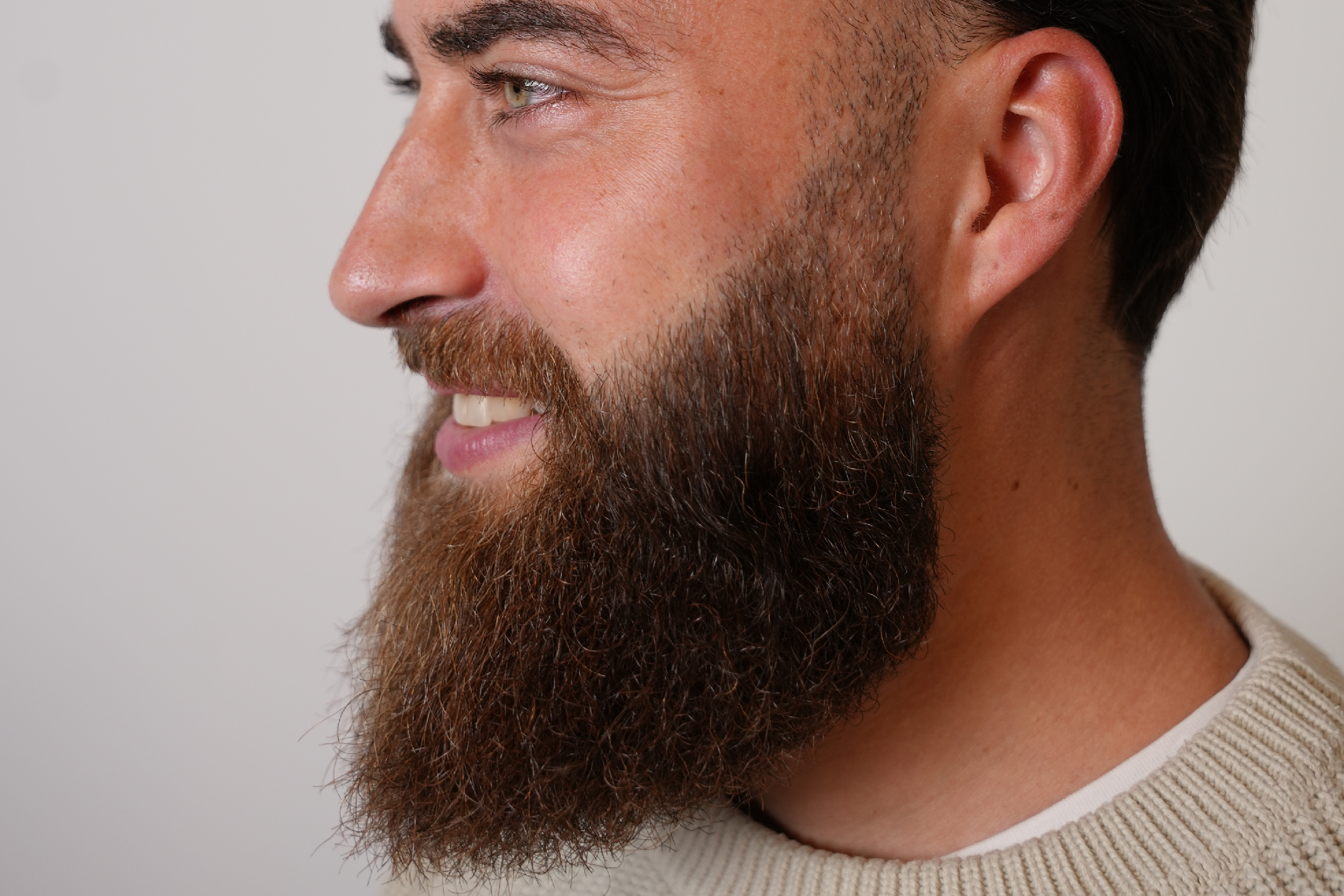 Le patient André a réalisé une greffe de barbe il y a 6 ans dans la clinique Elithair