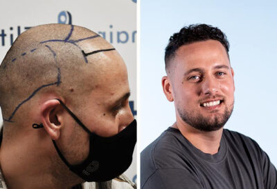 image avant apres la greffe DHI de Monier Achabar avec 4000 greffons