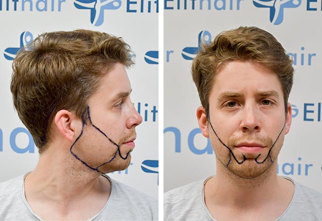 Eike R. Avant greffe de barbe saphir