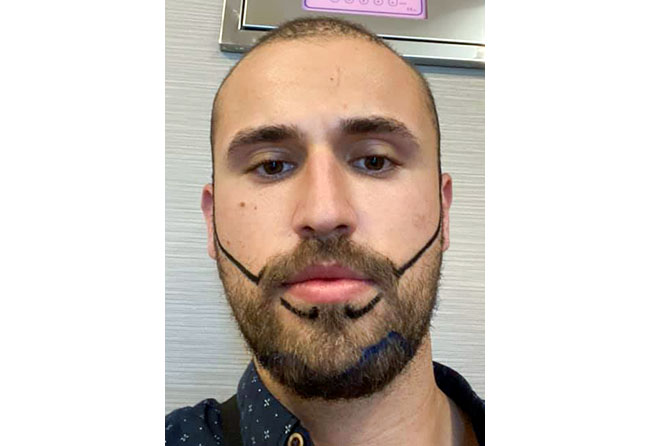 Hu Le greffe de barbe avant opération