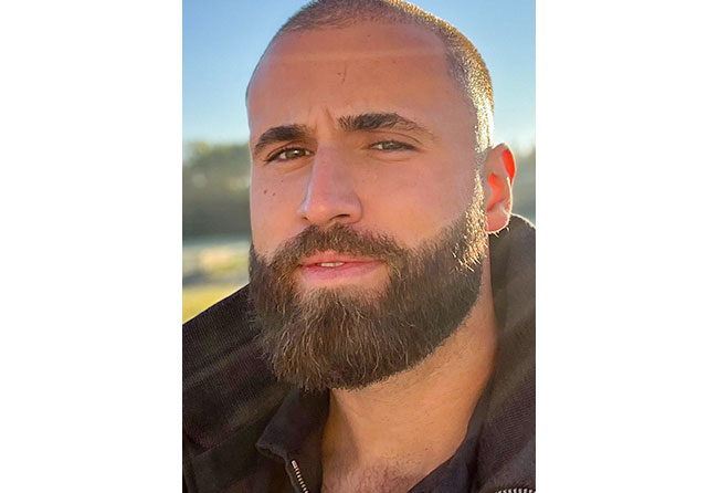 Patient Hu Le résultat après greffe de barbe