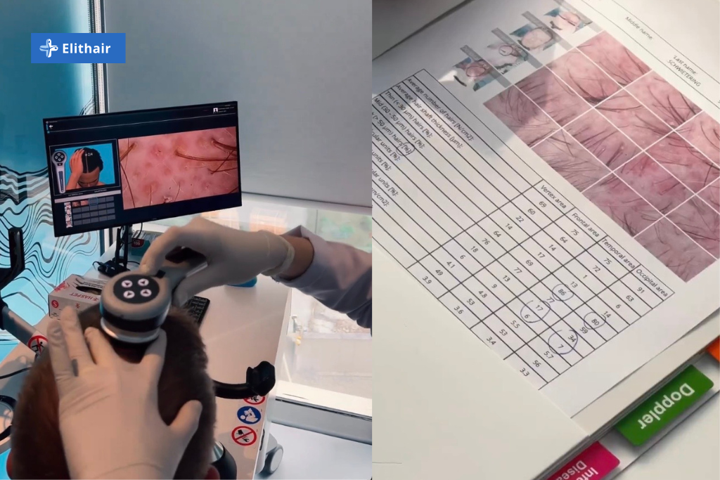 La clinique Elithair propose une analyse capillaire complète pour votre traitement contre la calvitie